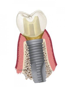 Tandwortel implantaat tand-kies