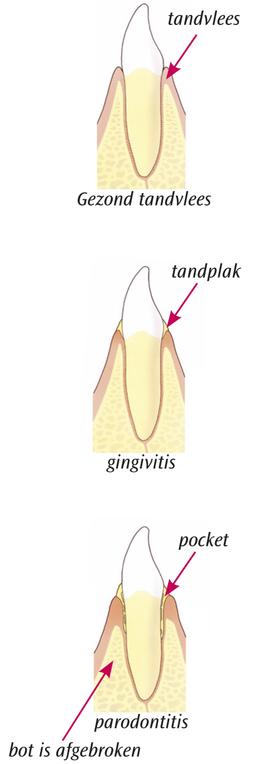 20121022145734403_gingivitis parodontitis (1)